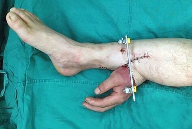 Surgeons Save Hand By Grafting It To Leg