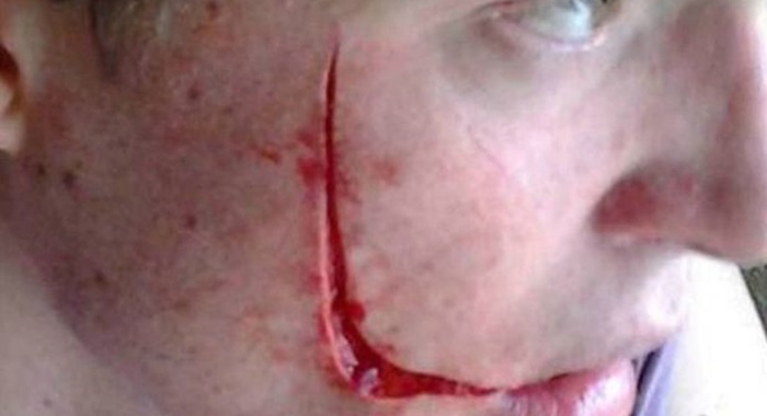 PAY-Liam-Newby-needed-39-stitches-after-his-face-was-slashed-in-horror-attack