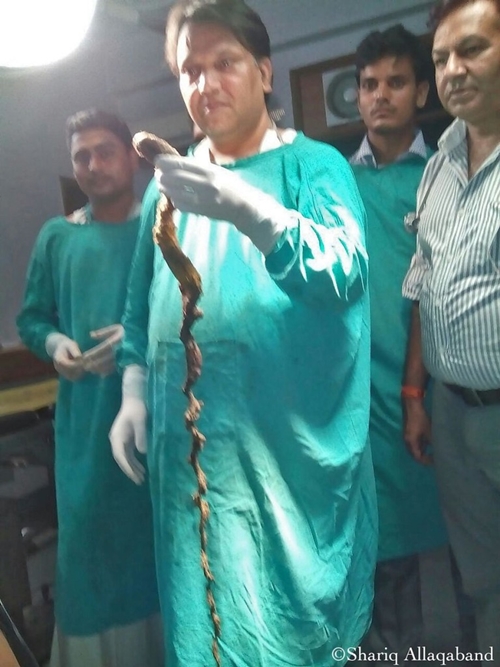 Rapunzel-syndrome-768x1024