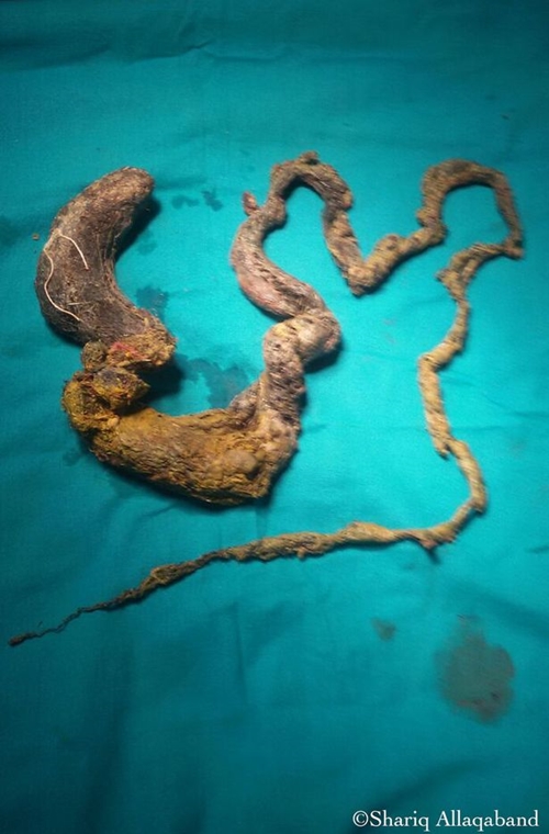 PAY-Hairball-removed-from-patient-suffering-Rapunzel-syndrome
