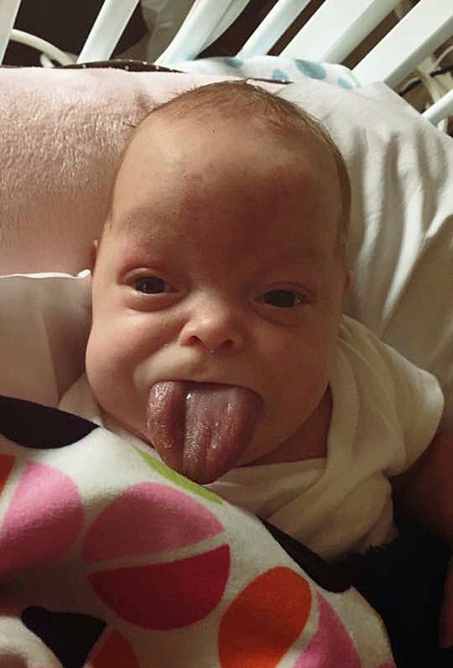 BABY WITH ADULT TONGUE FIRST SMI