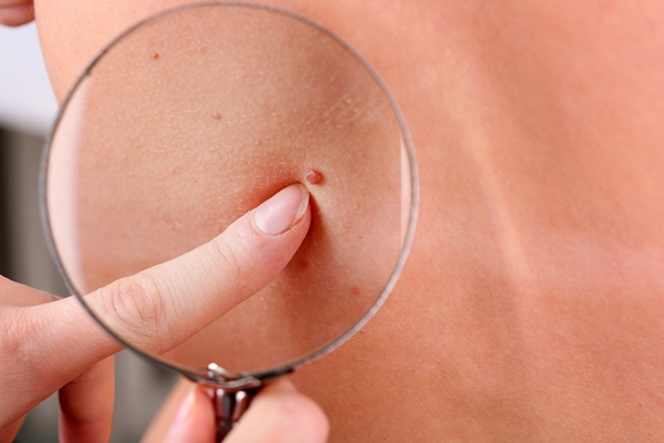 A dermatologist examining the birthmark of a patient
