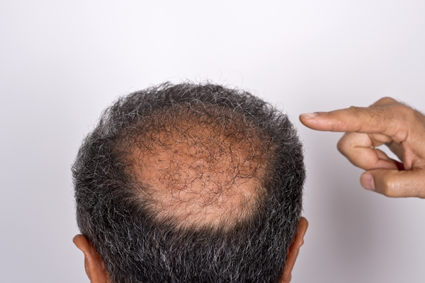 Rear view of a man's bald spot with hair growing back