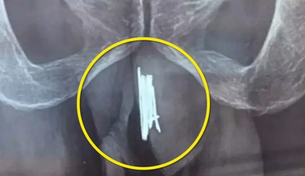 Man Inserts Needles Into Penis For Excitement