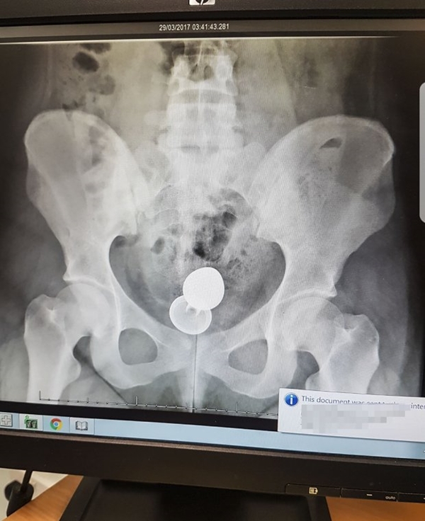 WOMAN, 20, REVEALS X-RAY OF 4-INCH SEX TOY STUCK UP BUM TO WARN OTHERS IN EMBARRASSING PREDICAMENTS TO SPEAK UP