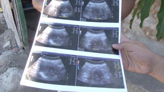 70세에 임신이 가능할까? 지난 24일 영국 미러 등 유럽언론은 멕시코 시날로아주 마사틀란에 사는 마리아 드라-루즈(70세) 할머니가 임신한 것으로 확인돼 의학계를 깜짝 놀라게 했다고 전했다. 약 7개월 전부터 구토