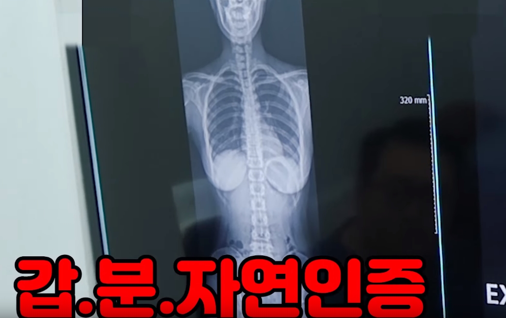 유명 유튜버가 엑스레이 찍는 장면을 영상을 통해 자신의 자연 H컵 가슴을 공개했다. 유튜버 김겨울은 ‘드디어 공개합니다’라는 제목의 영상을 최근 공개해 정형외과에서 허리 치료를 받는 모습을 보여줬다.