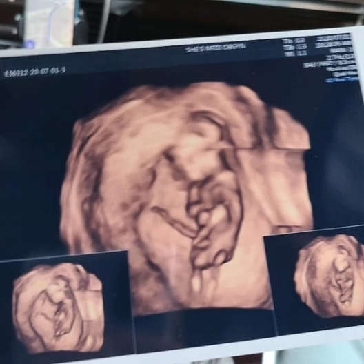 하리수 씨의 전남편 미키정이 아빠가 된다는 소식을 전했다. 지난 1일 미키정은 자신의 인스타그램에 태아의 초음파 사진을 공개하며 아내의 임신 소식을 알렸다. 이에 하리수 씨가 댓글을 달며 화제를 일으키�