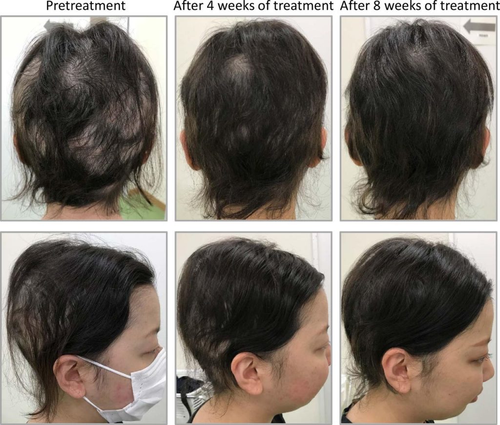 [속보] 탈모 머리카락 80% 회복하는 신약 개발