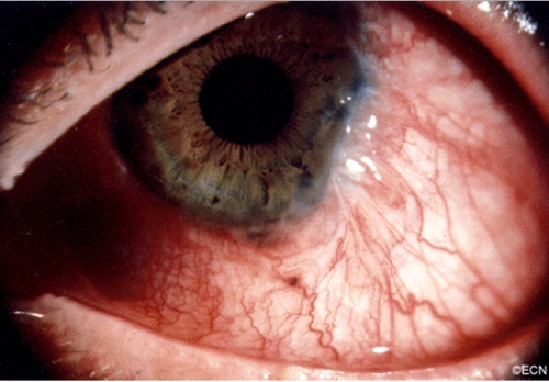 스마트폰안구암2