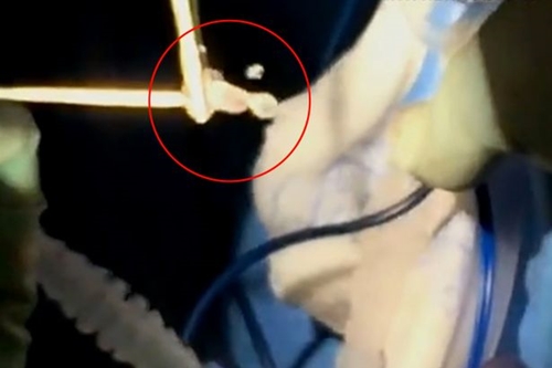 Texas-moms-headaches-caused-by-tapeworm-sacs-1 (1)