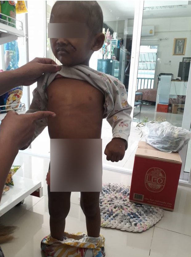 The power of social media saves 3-year-old Thai boy after father beat him