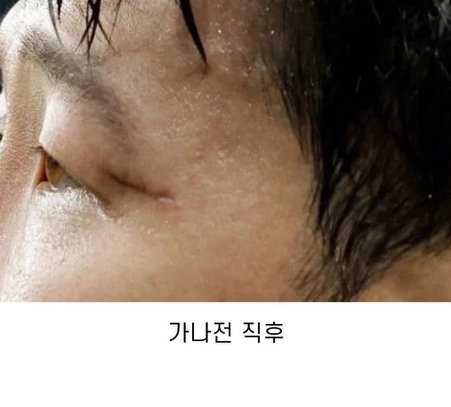 한국 가나전 이후 더 극심해진 손흥민 안와골절 부상 상태 사진