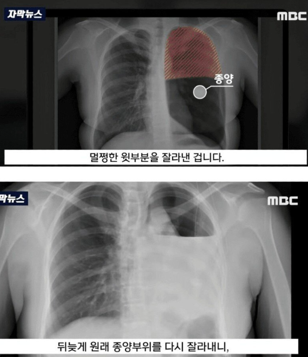 수술이후 알게된 충격적인 진실
